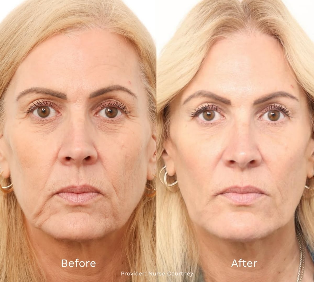 Before and After Result