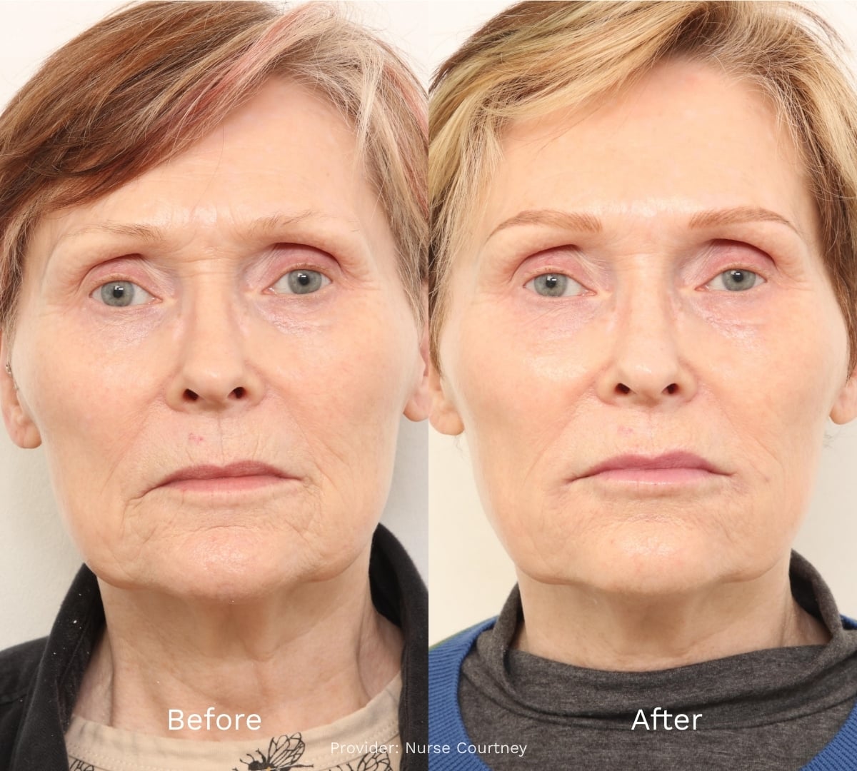 Before and After Result