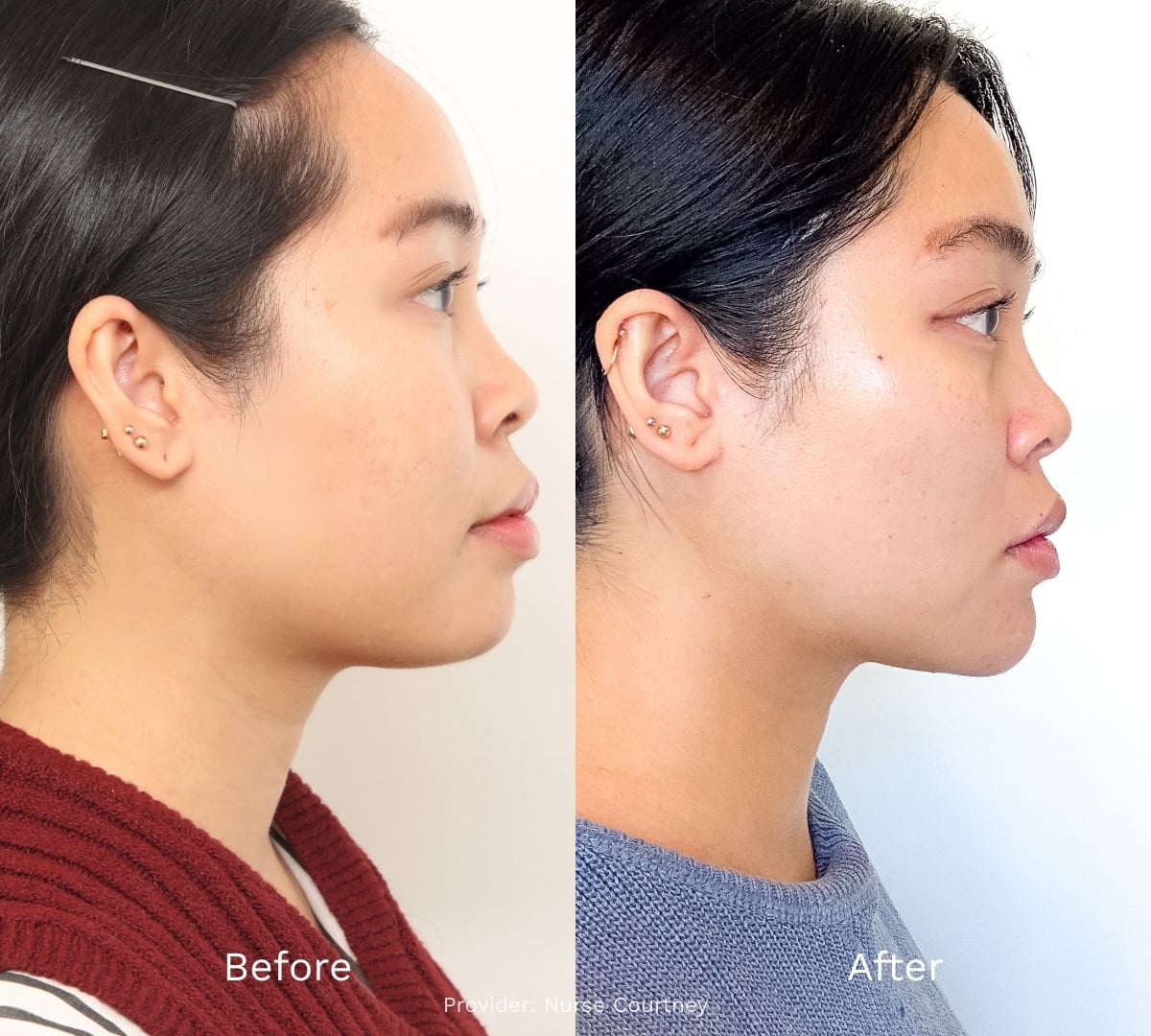 Before and After Result