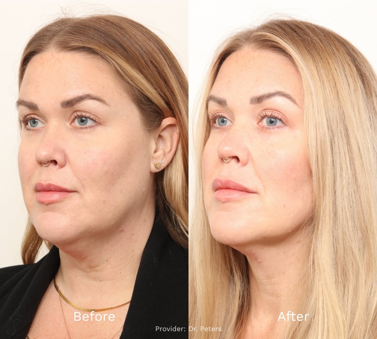 Before and After Result