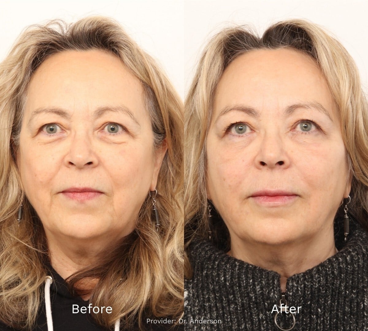 Before and After Result